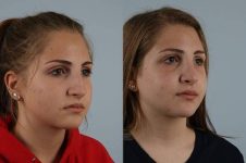 before and after rhinoplasty female patient right diagonal view case 3726