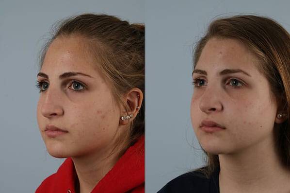 before and after rhinoplasty female patient left diagonal view case 3726