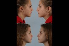 before and after rhinoplasty female patient right and left side view case 3726