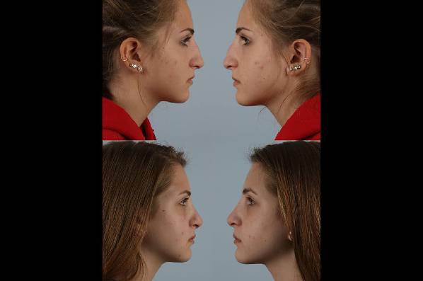 before and after rhinoplasty female patient right and left side view case 3726