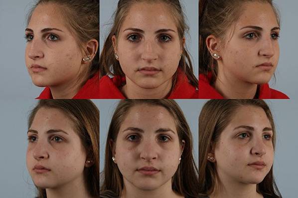 before and after rhinoplasty female patient multiple angle view case 3726