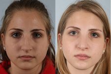 before and after rhinoplasty female patient front case view 3726