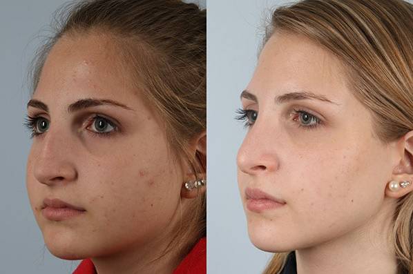 before and after rhinoplasty female patient left diagonal view case 3726