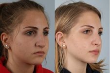 before and after rhinoplasty female patient right diagonal view case 3726