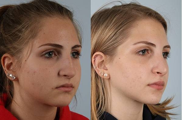 before and after rhinoplasty female patient right diagonal view case 3726
