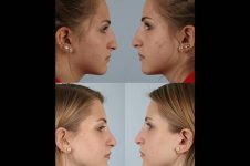 before and after rhinoplasty female patient right and left side view case 3726