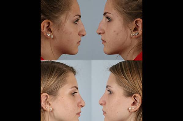 before and after rhinoplasty female patient right and left side view case 3726