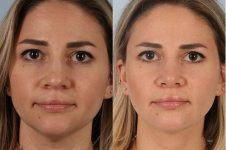 before and after rhinoplasty female patient front view case 3735