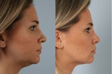 before and after rhinoplasty female patient right side view case 3735
