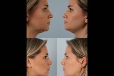 before and after rhinoplasty female patient left and right side view case 3735