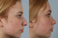 before and after rhinoplasty female patient right side view case 3740