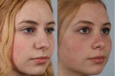before and after rhinoplasty female patient right diagonal view case 3740