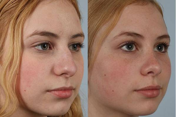 before and after rhinoplasty female patient right diagonal view case 3740