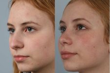 before and after rhinoplasty female patient left diagonal view case 3740