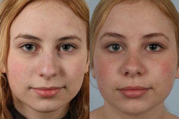 before and after rhinoplasty female patient front view case 3740