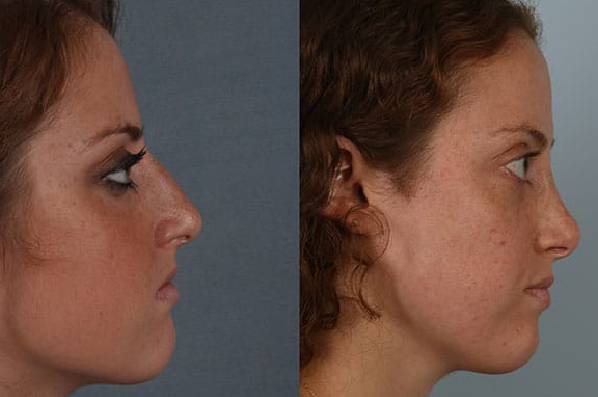 before and after rhinoplasty female patient right side view case 3745