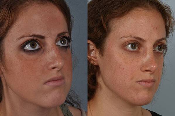 before and after rhinoplasty female patient right diagonal view case 3745