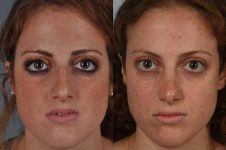 before and after rhinoplasty female patient front view case 3745