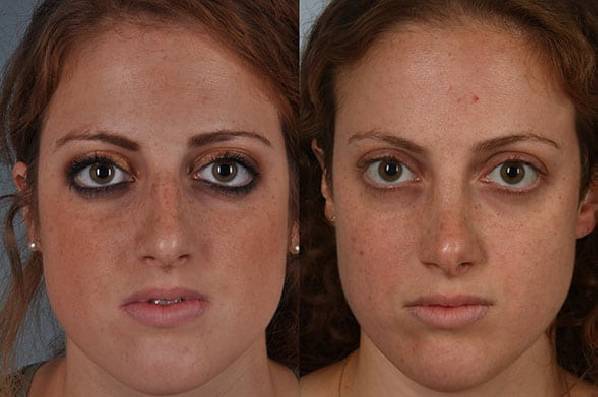 before and after rhinoplasty female patient front view case 3745