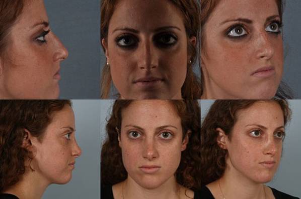 before and after rhinoplasty female patient multiple angle view case 3745