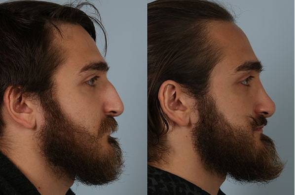 before and after rhinoplasty male patient right side view case 3750