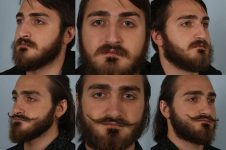 before and after rhinoplasty male patient multiple angle view case 3750