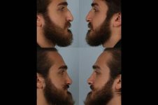 before and after rhinoplasty male patient left and right side view case 3750