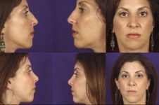 before and after rhinoplasty female patient multiple angles case 3609