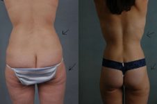 before and after total body lift female patient back view case 3059