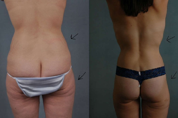 before and after total body lift female patient back view case 3059