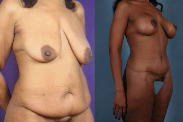 before and after total body lift female patient left diagonal view case 3056