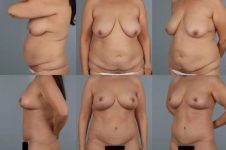 before and after total body lift female patient multiple angle view case 3050