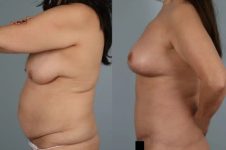 before and after total body lift female patient left side view case 3050