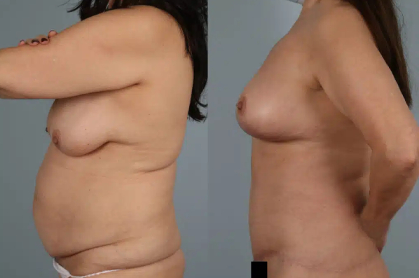 before and after total body lift female patient left side view case 3050