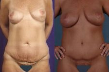 before and after total body lift female patient front view case 3045
