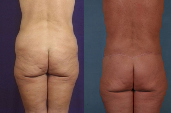 before and after total body lift female patient back view case 3045