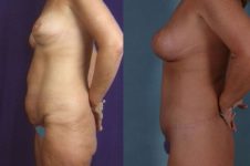before and after total body lift female patient left side view case 3045