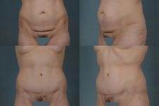 before and after total body lift female patient multiple angle view case 3031