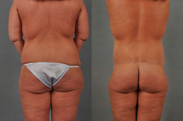 before and after total body lift female patient back view case 3022