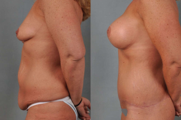 before and after total body lift female patient left side view case 3022