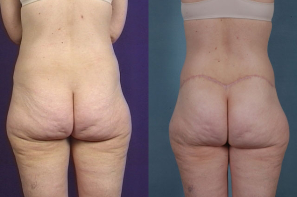 before and after total body lift female patient back view case 3018