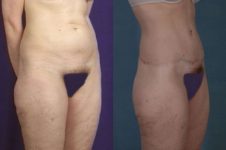 before and after total body lift female patient right diagonal view case 3018