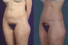 before and after total body lift female patient left diagonal view case 3018