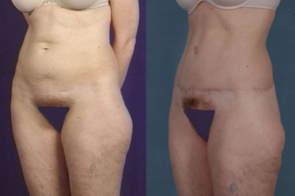 before and after total body lift female patient left diagonal view case 3018