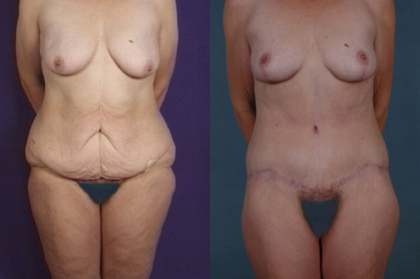 before and after total body lift female patient front view case 3016