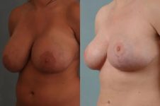 before and after breast revision female patient left diagonal view case 3397