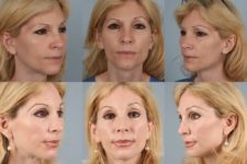 before and after facelift and neck lift female patient multiple angle view case 5852