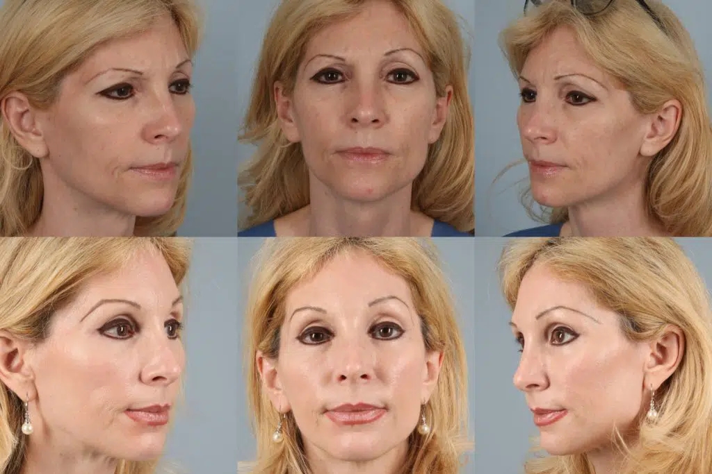 before and after facelift and neck lift female patient multiple angle view case 5852
