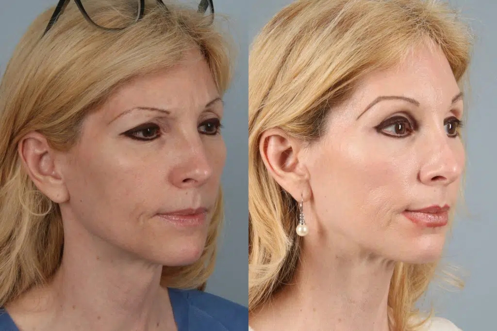 before and after facelift and neck lift female patient right diagonal view case 5852