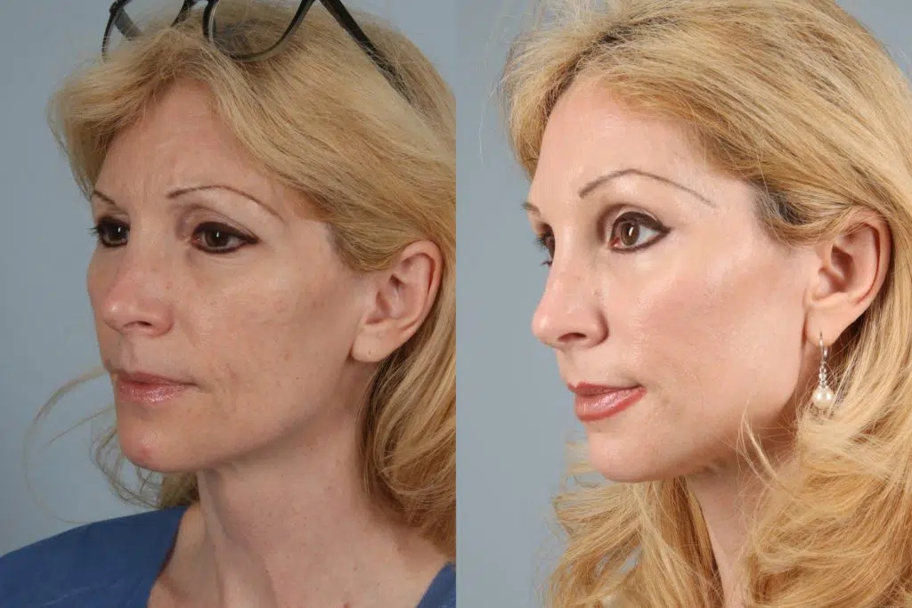 before and after facelift and neck lift female patient left diagonal view case 5852